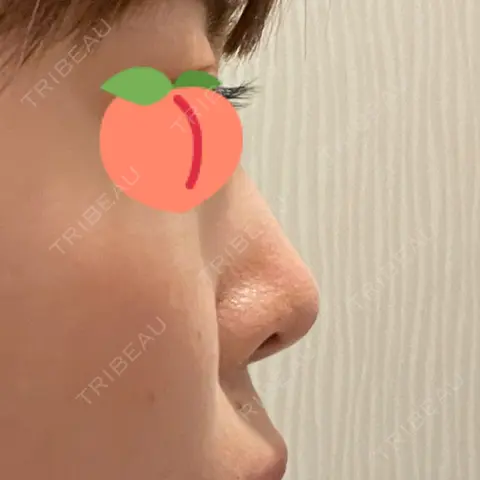 軟骨移植 フェアクリニック川口 AFTER