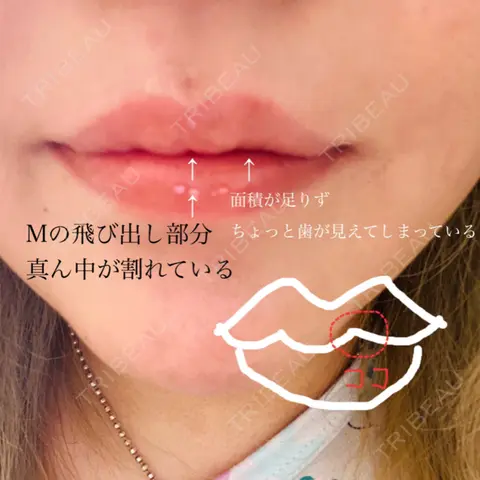 ヒアルロン酸注入（唇） EMMO FACE CLINIC 大阪梅田院 BEFORE