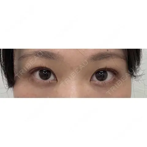 ヒアルロン酸注入（涙袋） 渋谷美容外科クリニック 新橋院 AFTER