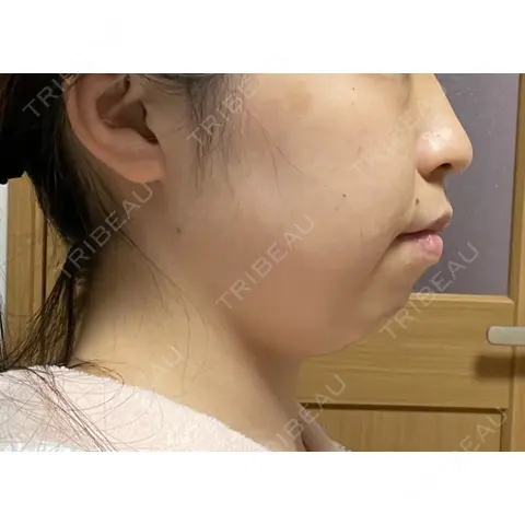 糸リフト / 脂肪吸引（顔） / ヒアルロン酸注入（頬） EMMO FACE CLINIC 大宮院 BEFORE