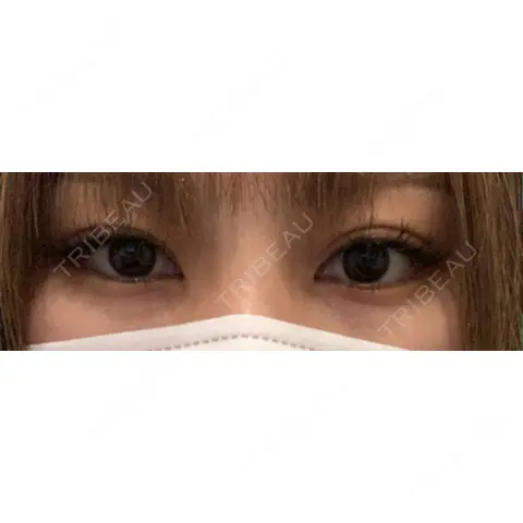 二重埋没 / 上まぶたの脂肪取り ながしまクリニック AFTER