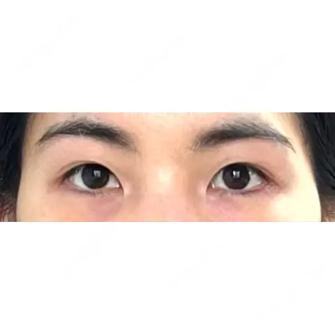 二重埋没 / 目頭切開 BIANCA表参道 AFTER