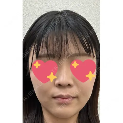 ピーリング（ニキビ・毛穴） ロナロナクリニック AFTER