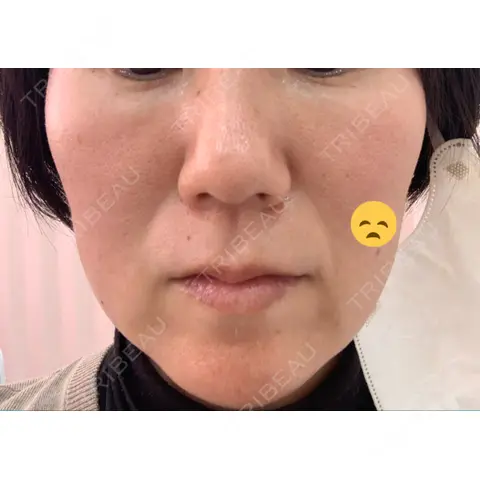 PRP皮膚再生療法 ノリス美容クリニック AFTER