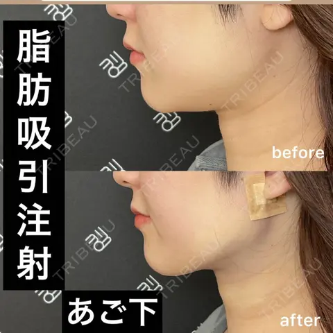 脂肪吸引（顔） EMMO FACE CLINIC 大阪梅田院 BEFORE