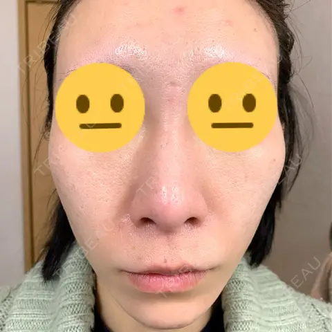 小鼻縮小（切開） / 人中短縮 / 鼻翼挙上 Otus Clinic 【オータスクリニック】 AFTER