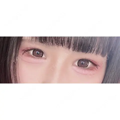 目尻切開 / タレ目形成・グラマラスライン（切開） 東京美容医療クリニック 池袋院 AFTER