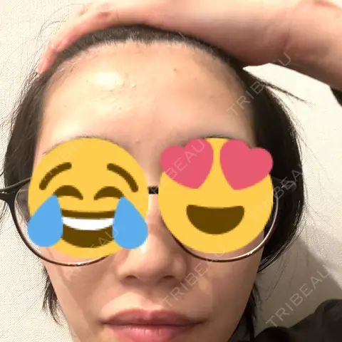 ピーリング（ニキビ・毛穴） ロナロナクリニック AFTER