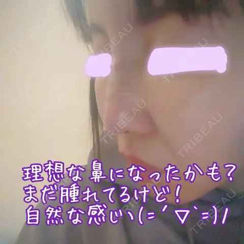 鼻修正 YBC横浜美容外科 大宮院 AFTER