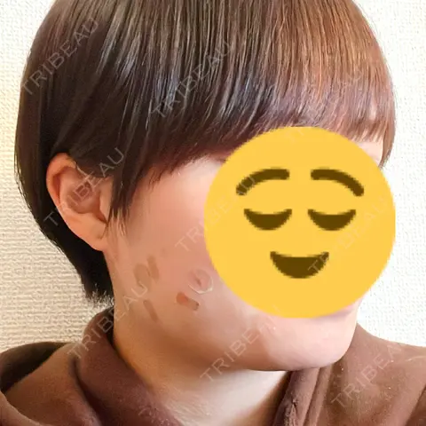 脂肪吸引（顔） EMMO FACE CLINIC 大阪梅田院 BEFORE