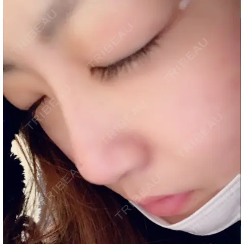 レディエッセ注入（鼻） トアロード形成美容クリニック AFTER