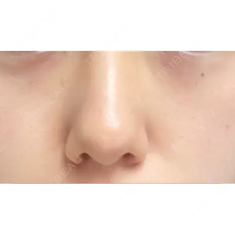小鼻縮小（切開） くさのたろうクリニック AFTER