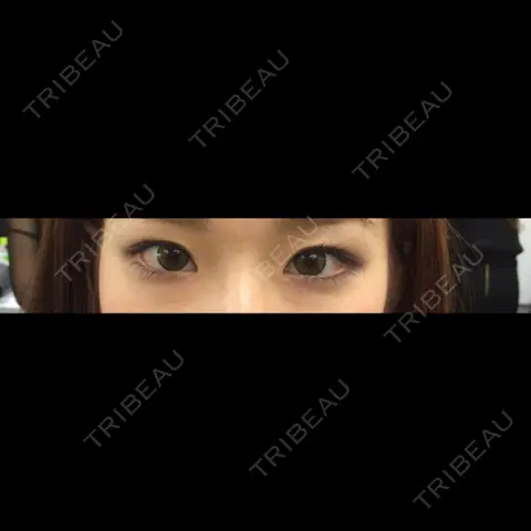 二重埋没 / 上まぶたの脂肪取り TCB東京中央美容外科 仙台駅前院 AFTER