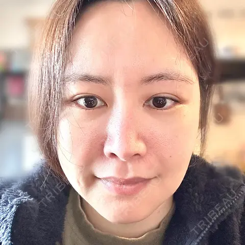 レーザートーニング（美白・肝斑） アクトリー勝どきウェルネスメディカルクリニック AFTER