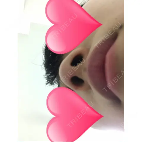 軟骨移植 / 鼻尖縮小 もとび美容外科クリニック 新宿院 AFTER