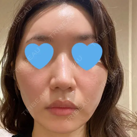 ポテンツァ LOUIS CLINIC 二子玉川院【ルイクリニック】 AFTER