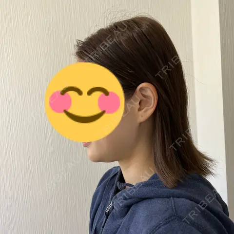 脂肪吸引（顔） EMMO FACE CLINIC 大阪梅田院 BEFORE