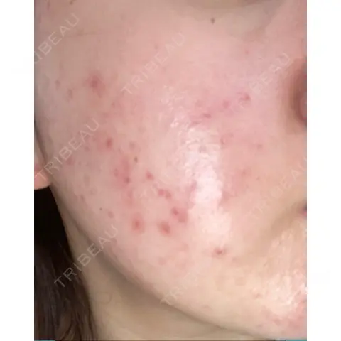ポテンツァ LOUIS CLINIC 二子玉川院【ルイクリニック】 AFTER