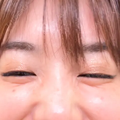 その他（目元） ももスキンケアクリニック AFTER