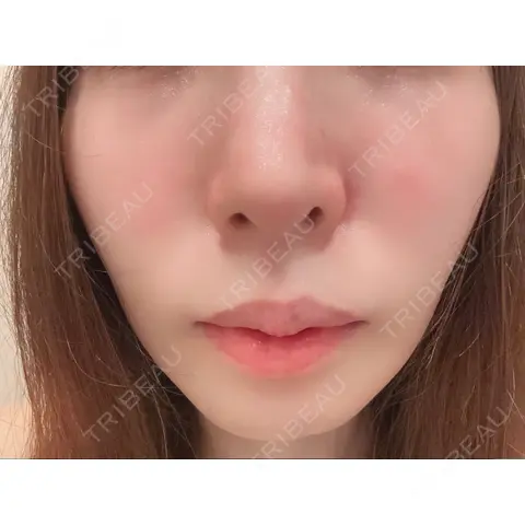 人中短縮 / 口角挙上 Venus beauty clinic 新宿院 AFTER
