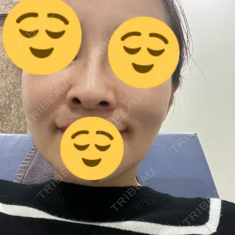 ボトックス（エラ・小顔） / 美容点滴・美容注射（疲労回復） / その他（鼻） HAAB×DREAM BEAUTY CLINIC 東京本院 AFTER