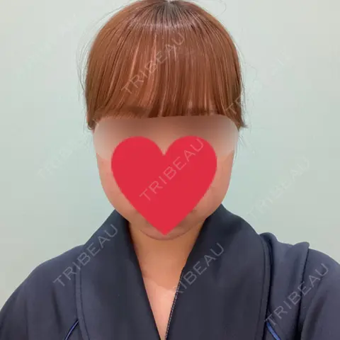 バッカルファット除去 / 脂肪吸引（顔） / ボトックス（エラ・小顔） WOM CLINIC GINZA （ワム クリニック ギンザ） BEFORE