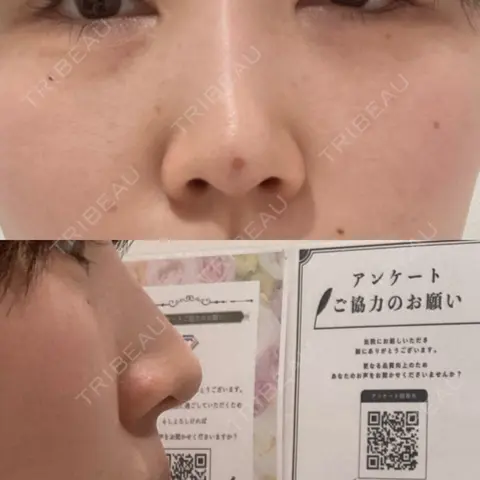 鼻尖形成（非切開） TCB東京中央美容外科 名古屋駅前院 AFTER