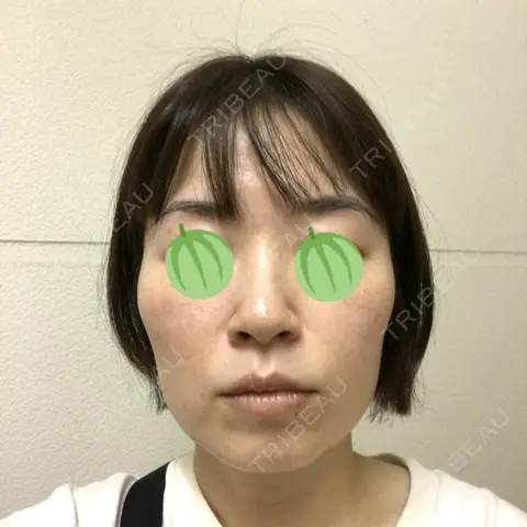 ボトックス（エラ・小顔） AI Beauty Clinic （エーアイ美容クリニック） BEFORE