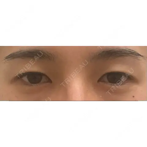 二重埋没 A CLINIC（エークリニック） 銀座院 AFTER