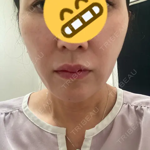 ボトックス（エラ・小顔） / 脂肪溶解注射（顔） / ピーリング（ニキビ・毛穴） ルラ美容クリニック 千葉院 AFTER