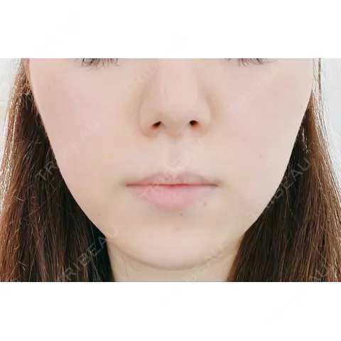 エレクトロポレーション 若倉診療所 AFTER