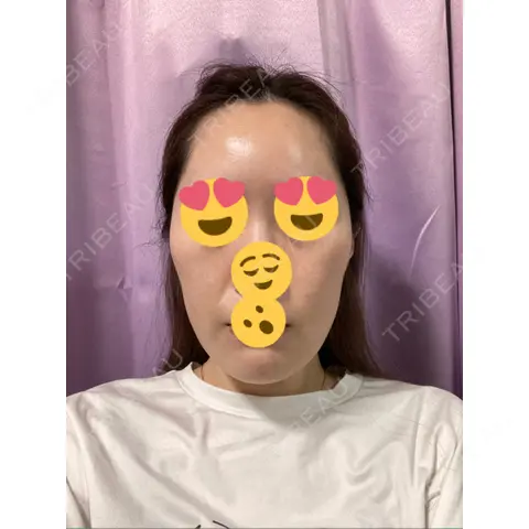 糸リフト The Natural Beauty Clinic 四ツ橋院 AFTER