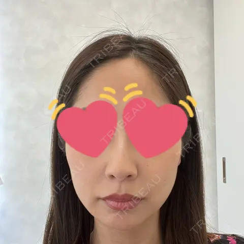 糸リフト YBC横浜美容外科 立川院 AFTER