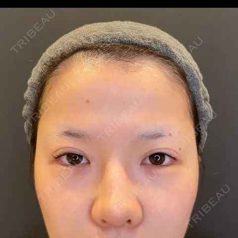 目尻切開 / タレ目形成・グラマラスライン（埋没） / 美容点滴・美容注射（美肌） LOUIS CLINIC 二子玉川院【ルイクリニック】 AFTER