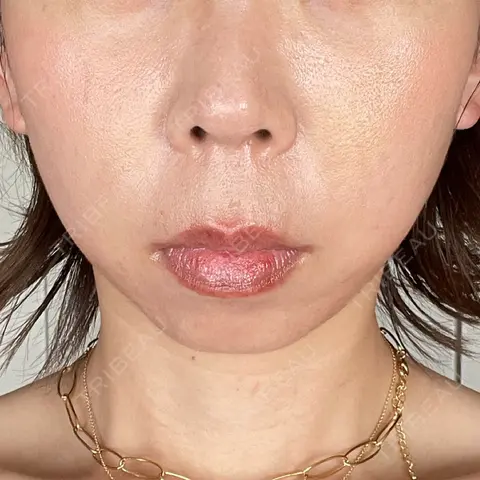 小鼻縮小（切開） / 鼻翼挙上 Otus Clinic 【オータスクリニック】 AFTER