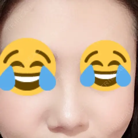 鼻尖形成（切開） / 鼻中隔延長（切開） / 小鼻縮小（切開） HANABI整形外科 AFTER
