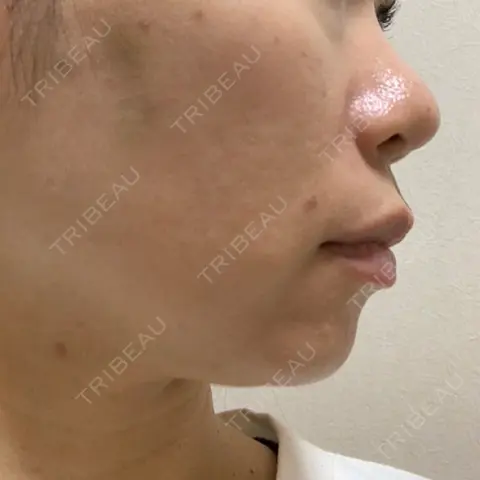 肌ヒアルロン酸注入（たるみ・シワ改善） / ヒアルロン酸注入（あご） シェリークリニック 福岡院 AFTER