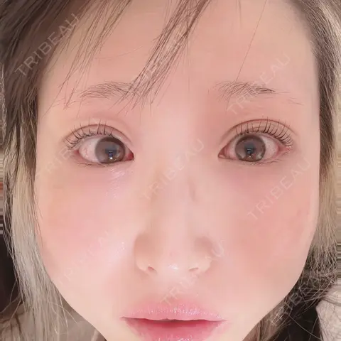 二重切開 / 目頭切開 / 目尻切開 / 下まぶたの脂肪取り / ヒアルロン酸注入（目の下） 湘南美容クリニック 岐阜院 AFTER