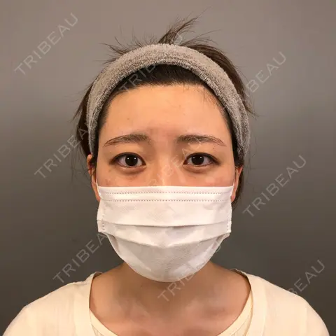 二重埋没 BELINDA CLINIC（ベリンダクリニック）新宿院 BEFORE