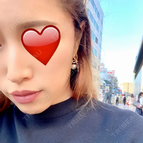 PRP皮膚再生療法 EMMO FACE CLINIC 大宮院 AFTER