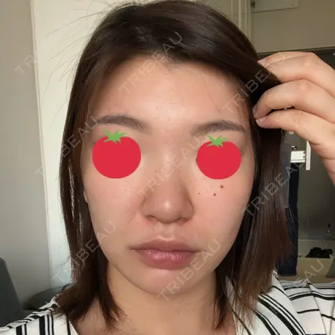 鼻尖形成（切開） / 鼻中隔延長（切開） / 脂肪溶解注射 / ボトックス（肩） / その他（鼻） エートップ美容整形外科 AFTER