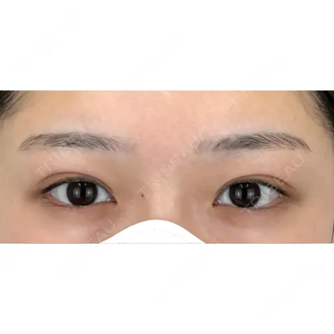 目頭切開 AI Beauty Clinic （エーアイ美容クリニック） BEFORE