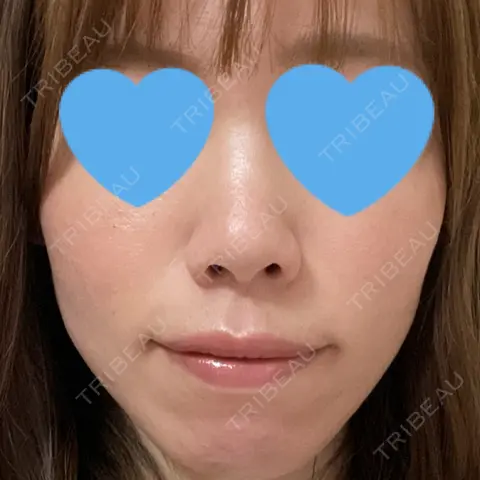ヴェルヴェットスキン KOBE美容皮膚科 神戸東灘院 AFTER