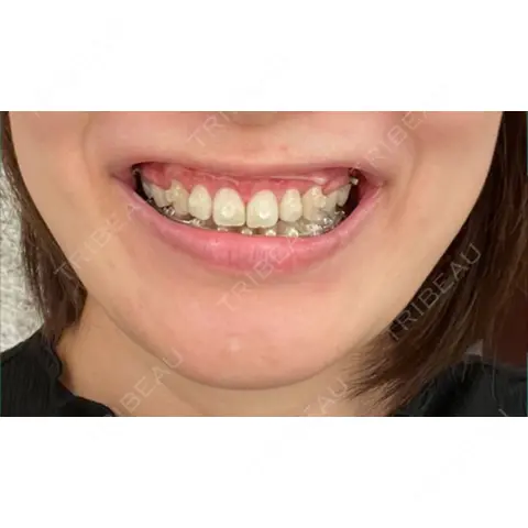 ボトックス（ガミースマイル） ヘアケアクリニック 六本木院 AFTER