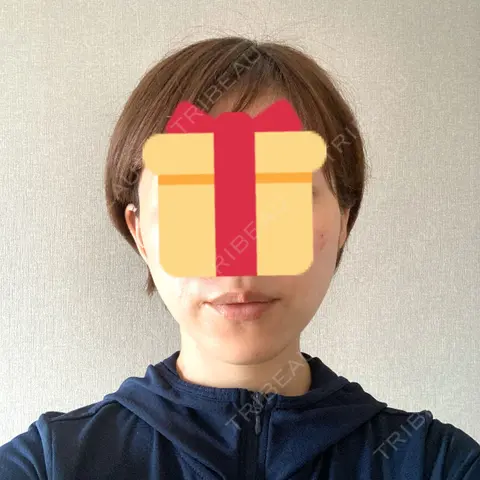 脂肪溶解注射（顔） 東京ロイヤルクリニック AFTER