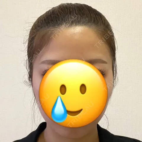 脂肪吸引（顔） EMMO FACE CLINIC 大阪梅田院 BEFORE