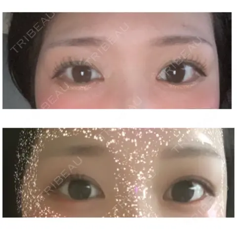 二重埋没 AI Beauty Clinic （エーアイ美容クリニック） BEFORE