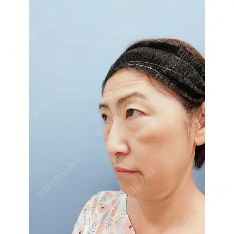 二重切開 湘南美容クリニック 西葛西院 AFTER