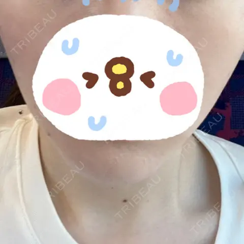 ハイフ（顔） あおばクリニック 名古屋栄院 AFTER