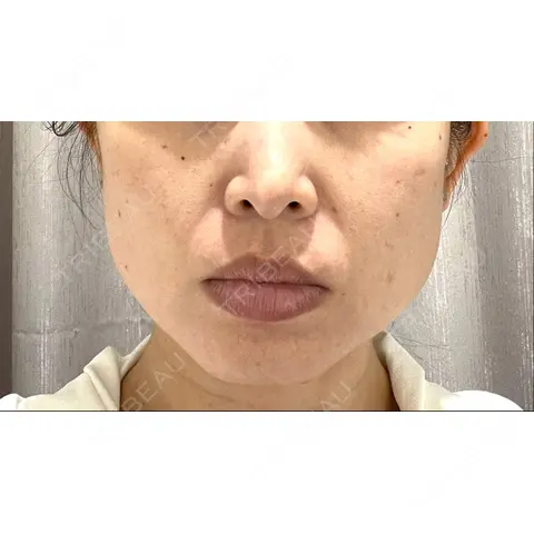 クマ治療 / ボトックス（エラ・小顔） / ハイフ（顔） EMMO FACE CLINIC 大宮院 AFTER